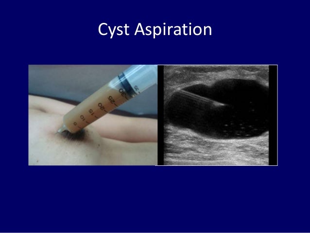 breast cyst asperation Lick it sex